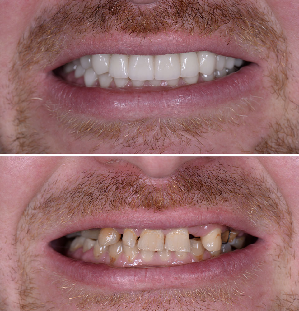 before & after dental implants
