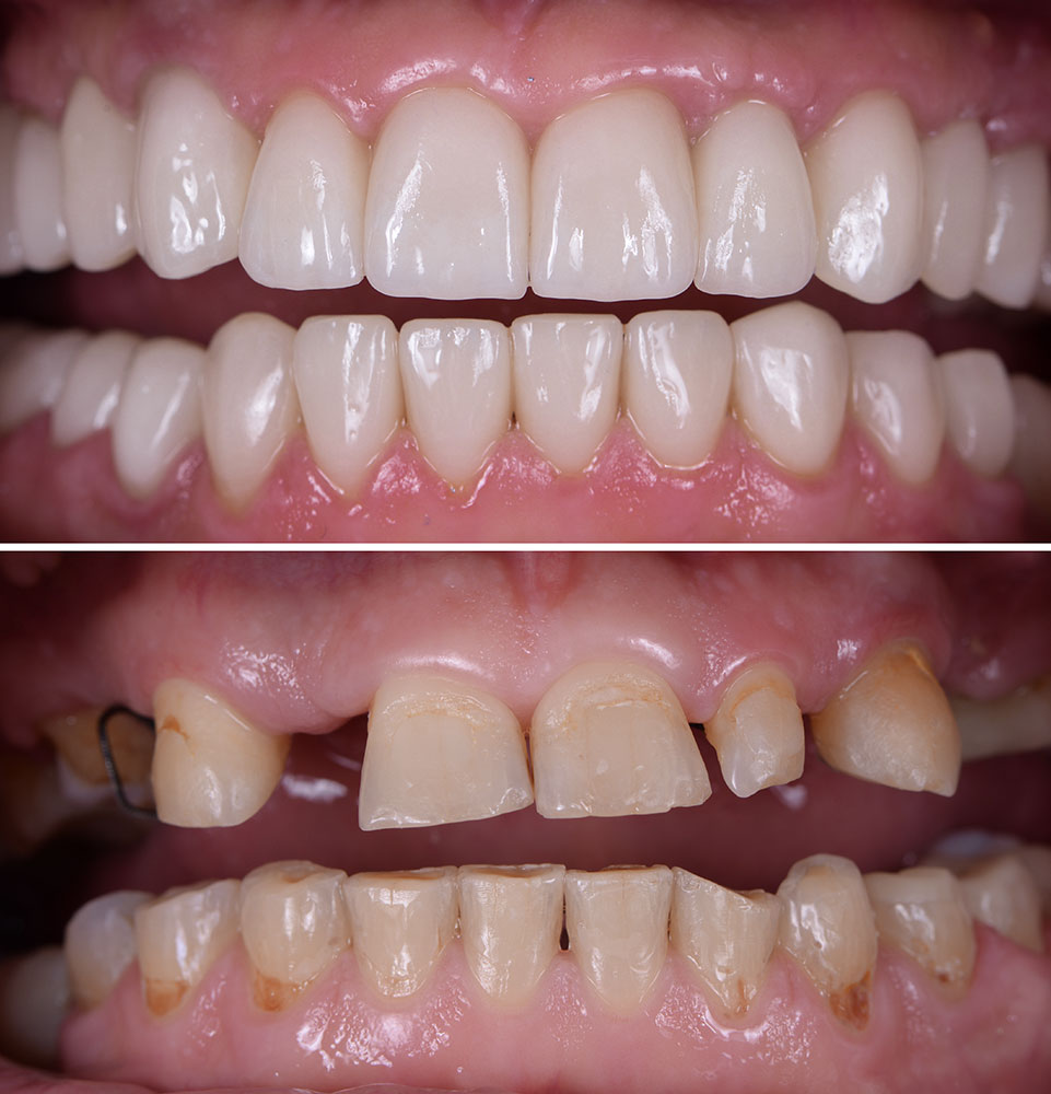 before & after dental implants