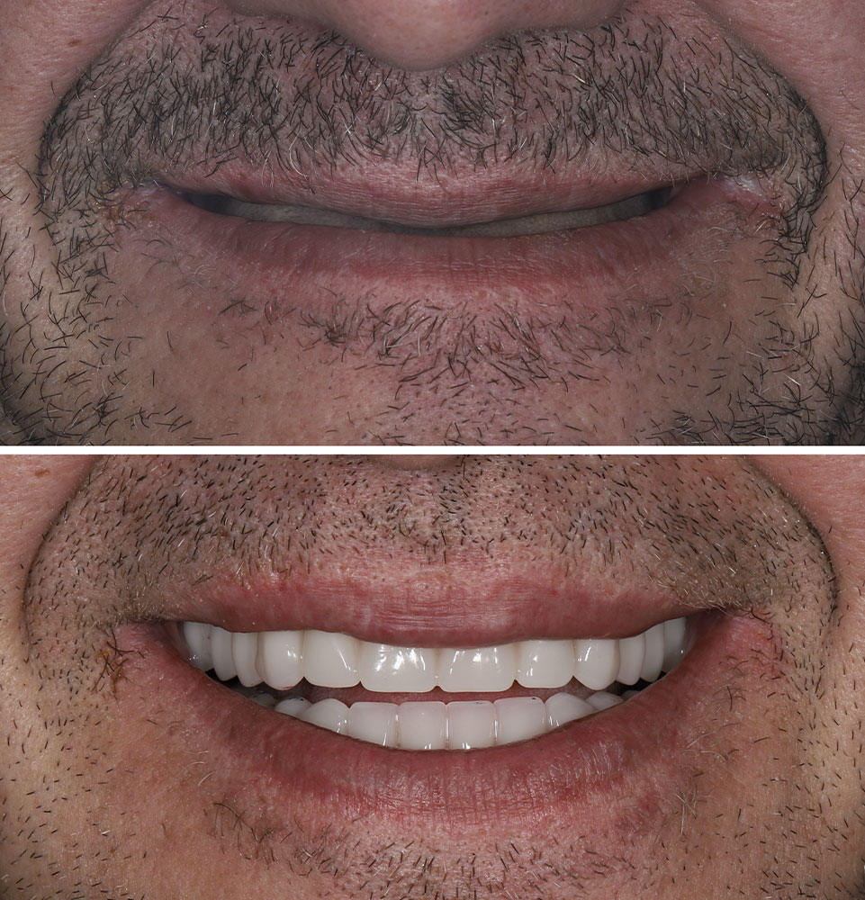 before & after dental implants