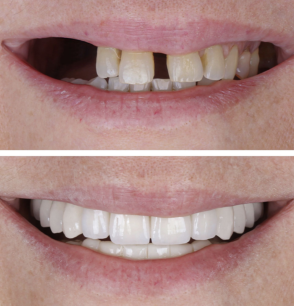 before & after dental implants