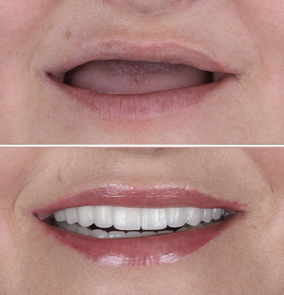 before & after dental implants