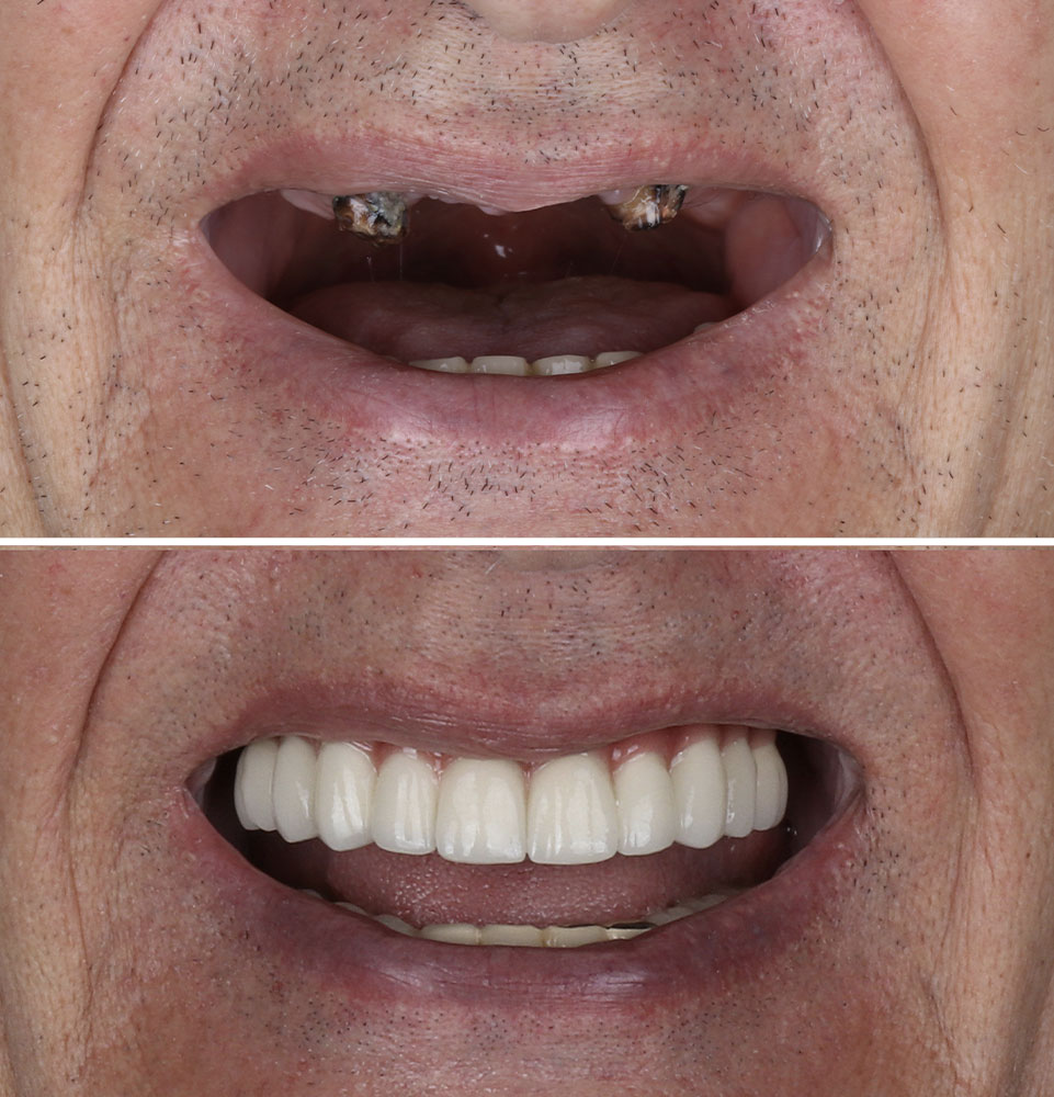 before & after dental implants