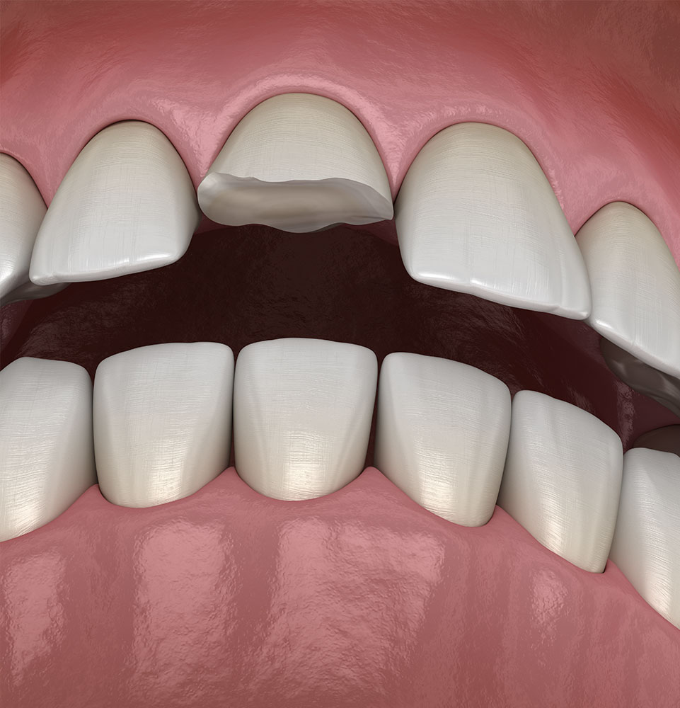 image of broken tooth