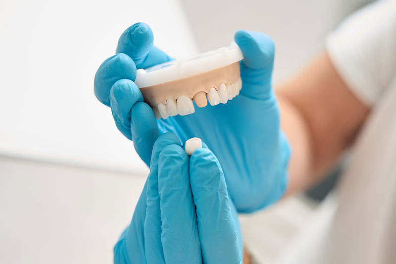 dental assisting wearing blue gloves holding model of a dental crown
