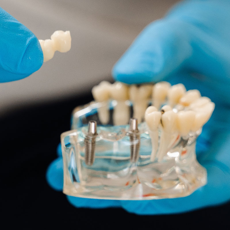 blue gloved hands holding dental implant bridge