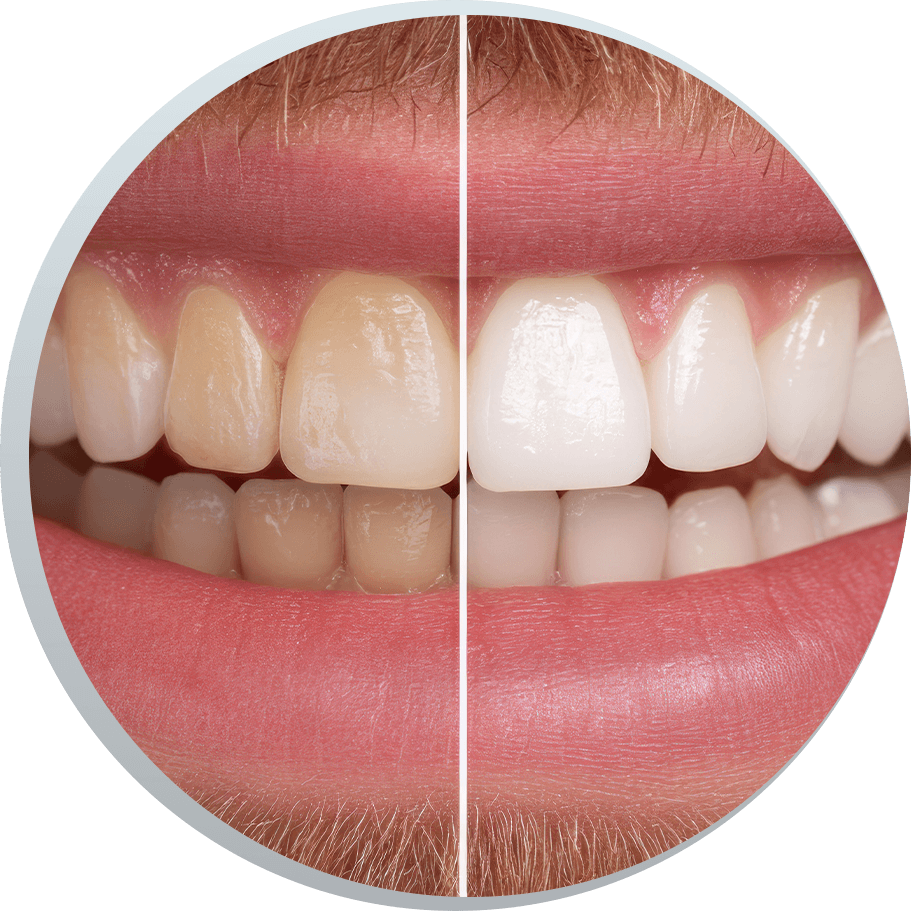 teeth whitening before and after