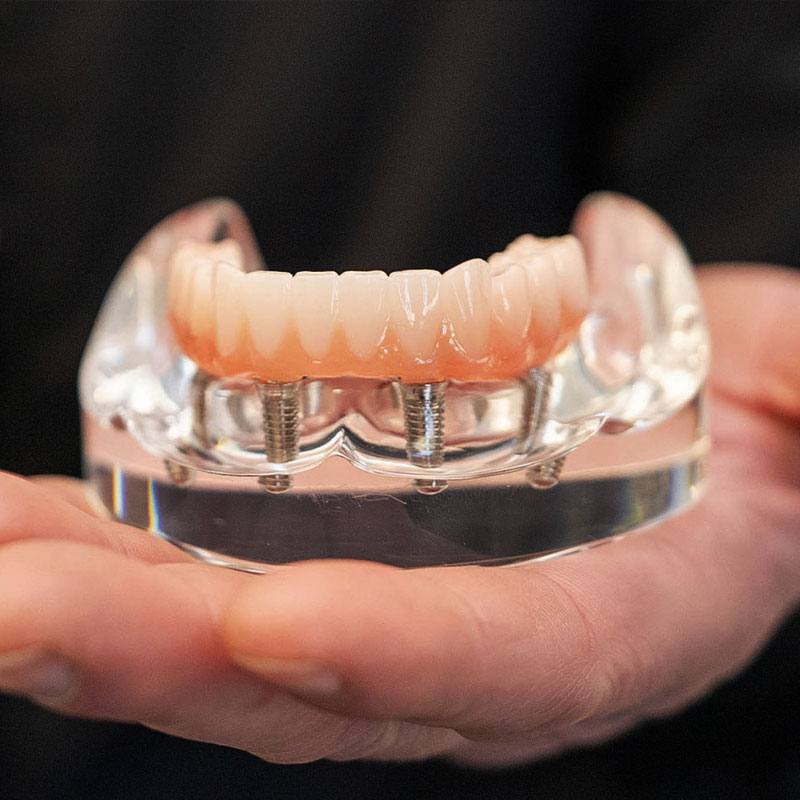 hands holding full-arch implant model