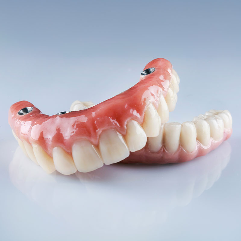 model of full arch dental implants