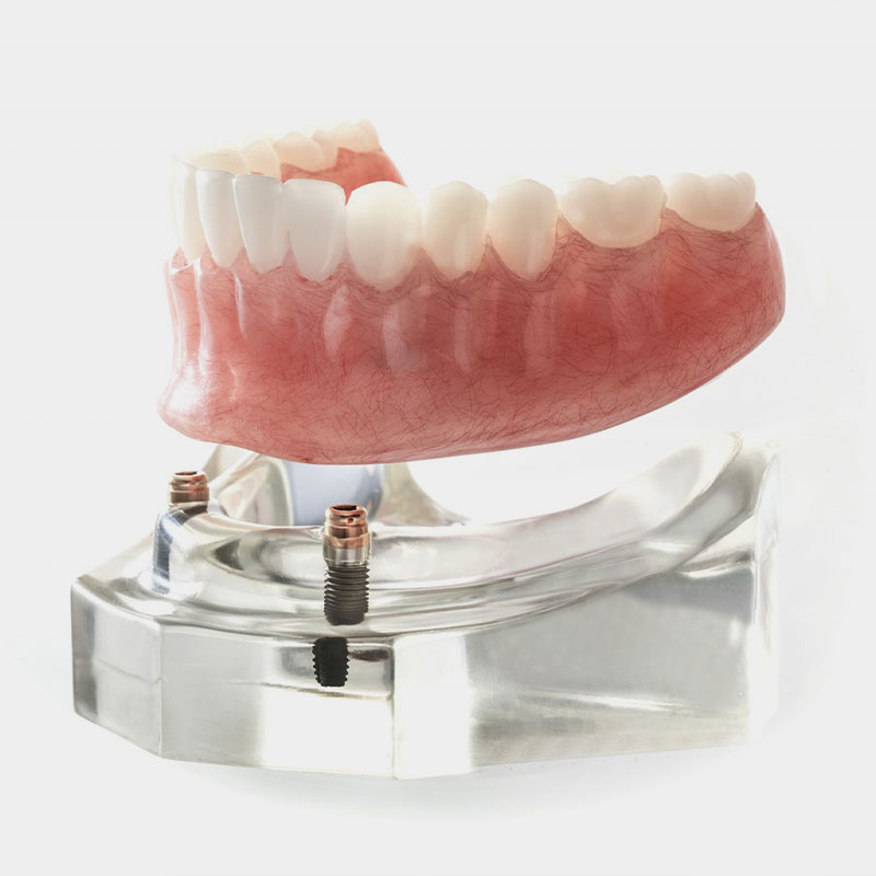 model of implant supported dentures