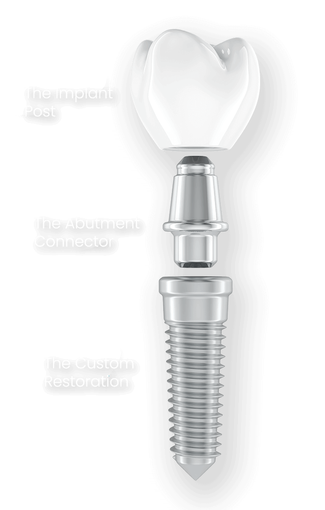 infographic describing the three parts of a dental implant