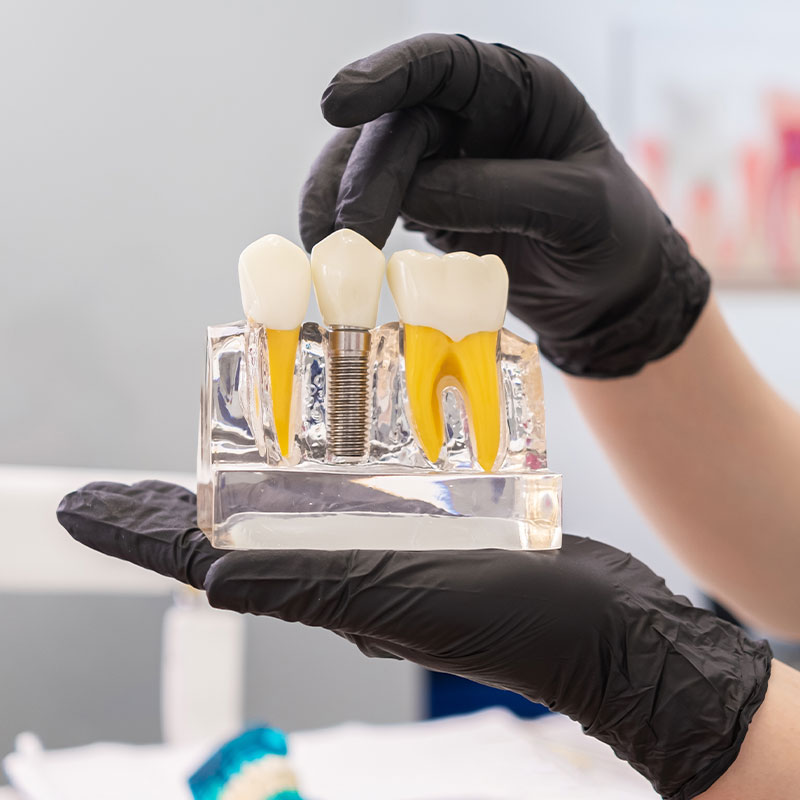 hands with black gloves holding dental implant model