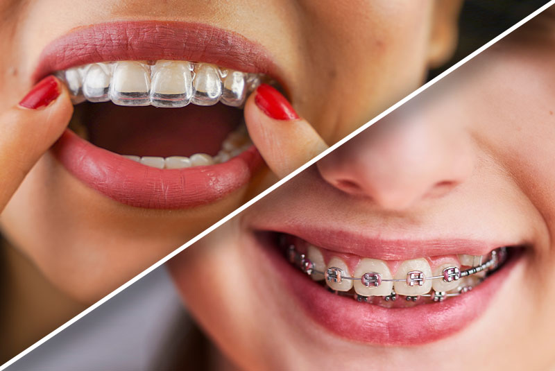 diagonal split view of clear aligners and braces