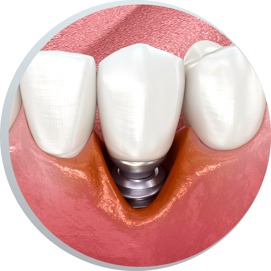 image of periimplantitis