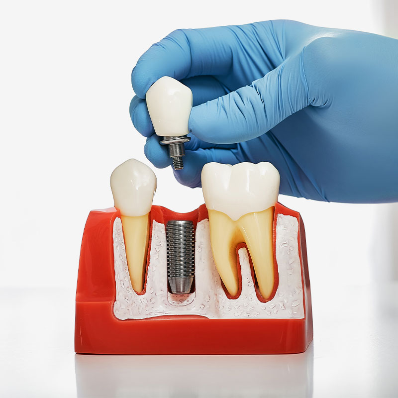 blue gloved hand holding dental implant model